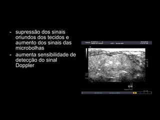 supressão dos sinais oriundos dos tecidos e aumento dos sinais das microbolhas aumenta sensibilidade de detecção do sinal Doppler 