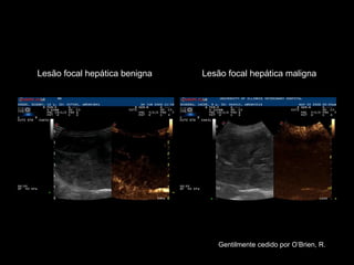 Lesão focal hepática benigna Lesão focal hepática maligna Gentilmente cedido por O’Brien, R. 