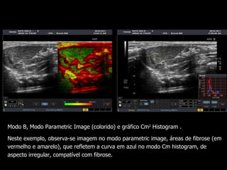 Modo B,  Modo Parametric Image (colorido) e gráfico Cm 2  Histogram . Neste exemplo, observa-se imagem no modo parametric image, áreas de fibrose (em vermelho e amarelo), que refletem a curva em azul no modo Cm histogram, de aspecto irregular, compatível com fibrose. 