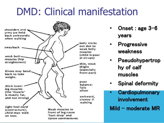 Muscular Dystrophy muscular-dystrophy