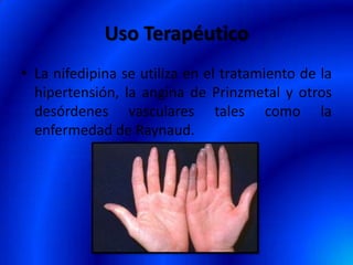 Uso Terapéutico
• La nifedipina se utiliza en el tratamiento de la
hipertensión, la angina de Prinzmetal y otros
desórdenes vasculares tales como la
enfermedad de Raynaud.
 