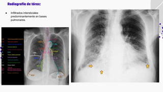 ● Infiltrados intersticiales
predominantemente en bases
pulmonares.
Radiografía de tórax:
 