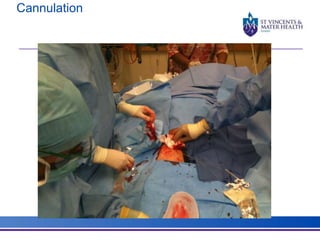 Cannulation 
 