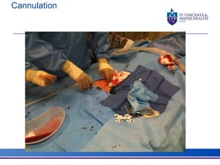 Cannulation 
 