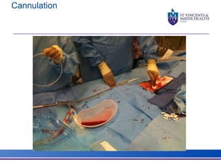 Cannulation 
 