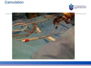 Cannulation 
 