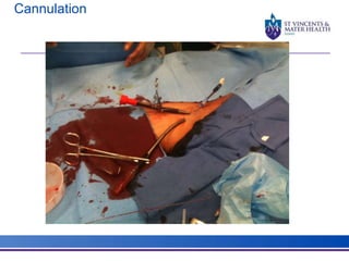 Cannulation 
 