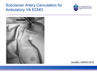 Subclavian Artery Cannulation for 
Ambulatory VA ECMO 
Javidfar, ASAIO 2012 
 