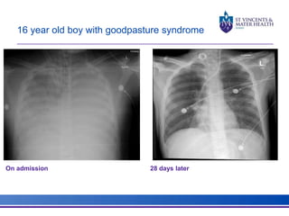 16 year old boy with goodpasture syndrome 
On admission 28 days later 
 