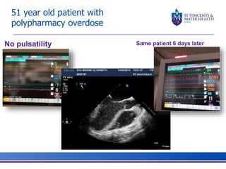51 year old patient with 
polypharmacy overdose 
No pulsatility Same patient 6 days later 
 