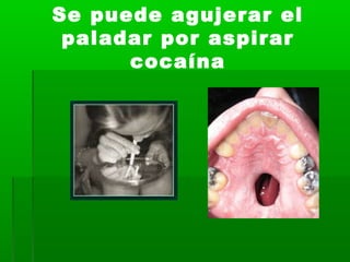 Se puede agujerar el
paladar por aspirar
cocaína
 