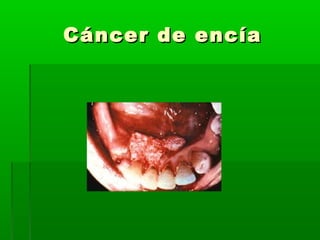 Cáncer de encíaCáncer de encía
 