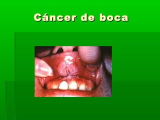 Cáncer de bocaCáncer de boca
 