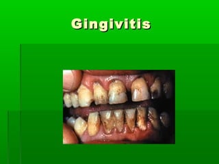 GingivitisGingivitis
 
