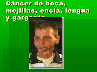 Cáncer de boca,Cáncer de boca,
mejillas, encía, lenguamejillas, encía, lengua
y gargantay garganta
 