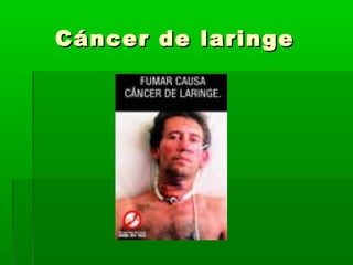 Cáncer de laringeCáncer de laringe
 