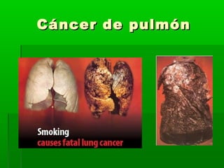 Cáncer de pulmónCáncer de pulmón
 