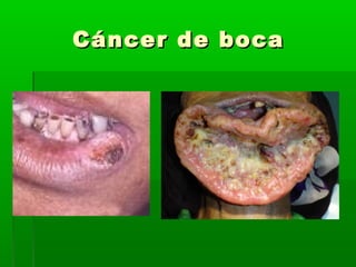 Cáncer de bocaCáncer de boca
 
