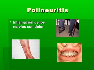 PolineuritisPolineuritis
 Inflamación de losInflamación de los
nervios con dolornervios con dolor
 