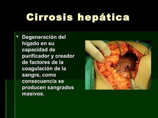 Cirrosis hepáticaCirrosis hepática
 Degeneración delDegeneración del
hígado en suhígado en su
capacidad decapacidad de
purificador y creadorpurificador y creador
de factores de lade factores de la
coagulación de lacoagulación de la
sangre, comosangre, como
consecuencia seconsecuencia se
producen sangradosproducen sangrados
masivos.masivos.
 