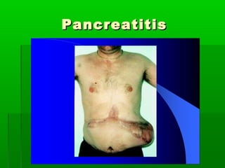 PancreatitisPancreatitis
 