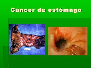 Cáncer de estómagoCáncer de estómago
 