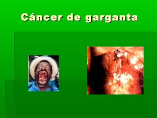 Cáncer de gargantaCáncer de garganta
 