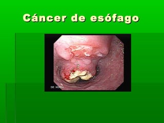 Cáncer de esófagoCáncer de esófago
 