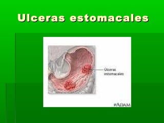 Ulceras estomacalesUlceras estomacales
 