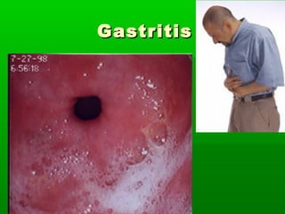GastritisGastritis
 