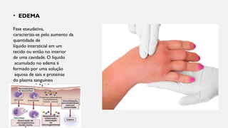 • EDEMA
Fase esxudativa,
caracteriza-se pelo aumento da
quantidade de
líquido intersticial em um
tecido ou então no interior
de uma cavidade. O líquido
acumulado no edema é
formado por uma solução
aquosa de sais e proteínas
do plasma sanguíneo
 