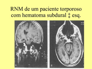 RNM de um paciente torporoso com hematoma subdural à esq. 