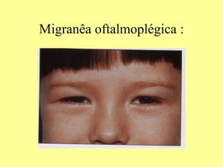 Migranêa oftalmoplégica : 