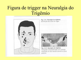 Figura de trigger na Neuralgia do Trigêmio 