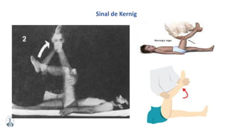 MFMM
Sinal de Kernig
 