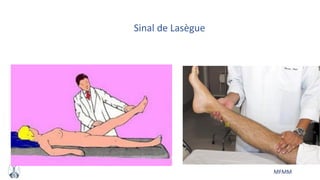 MFMM
Sinal de Lasègue
 