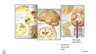 MFMM
Meningite
tuberculosa
Mal de Pott:
tuberculose
óssea
 