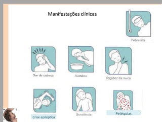 Crise epiléptica
Petéquias
Manifestações clínicas
 