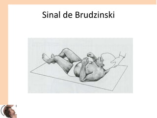 Sinal de Brudzinski
 