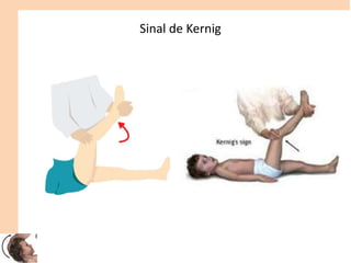 Sinal de Kernig
 