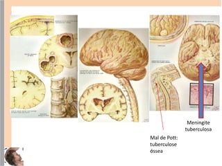 Meningite
tuberculosa
Mal de Pott:
tuberculose
óssea
 
