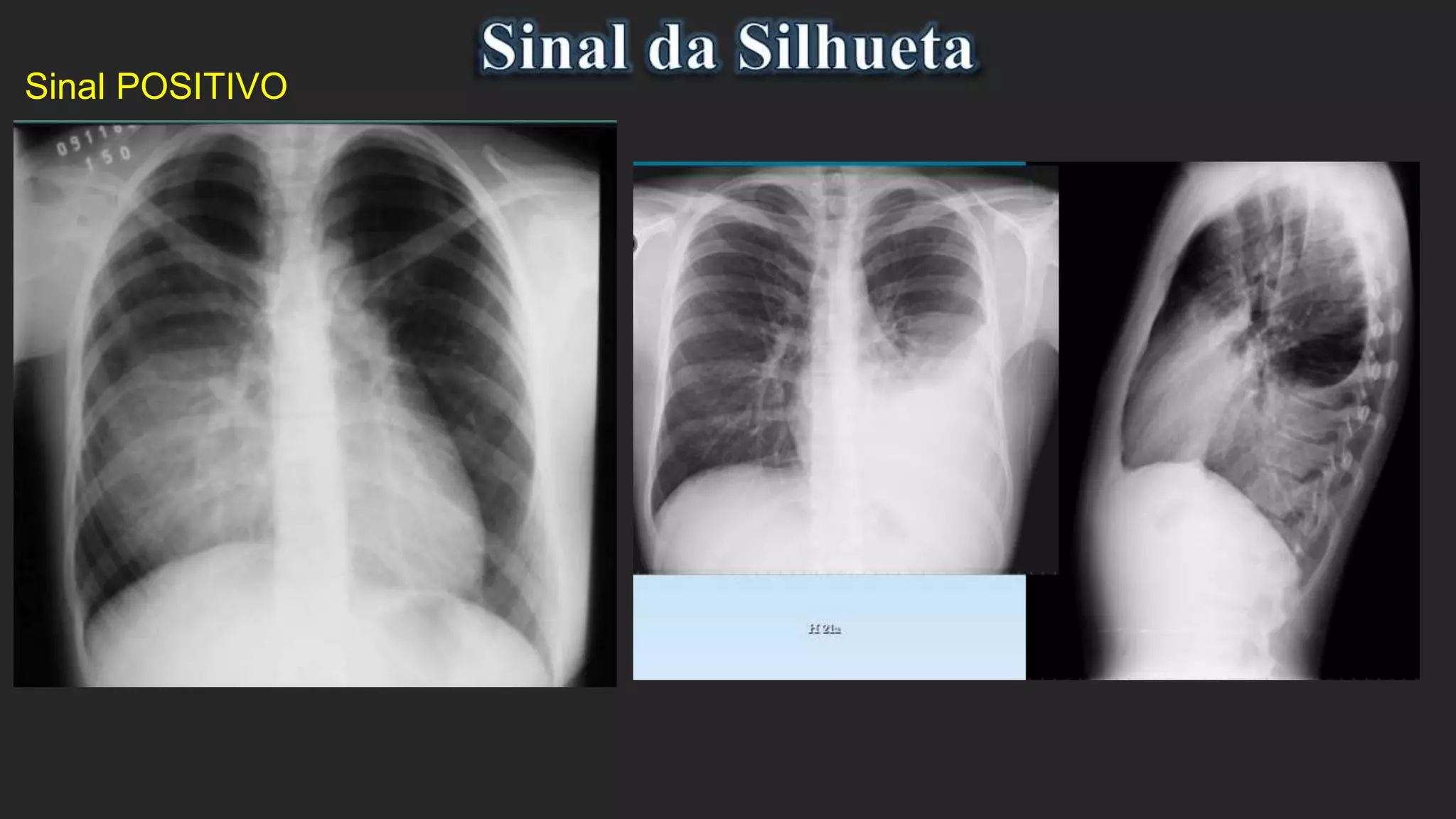 Sinais do Raio X de Tórax | PPTX