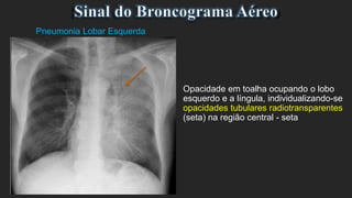 Pneumonia Lobar Esquerda
Opacidade em toalha ocupando o lobo
esquerdo e a língula, individualizando-se
opacidades tubulares radiotransparentes
(seta) na região central - seta
 