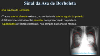 Sinal da Asa de Borboleta:
- Traduz edema alveolar extenso, no contexto de edema agudo do pulmão.
- Infiltrado interstício-alveolar parahilar com preservação da periferia.
- Opacidades alveolares bilaterais, nos campos pulmonares médios.
 