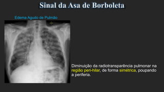 Diminuição da radiotransparência pulmonar na
região peri-hilar, de forma simétrica, poupando
a periferia.
Edema Agudo de Pulmão
 