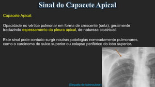 Capacete Apical:
Opacidade no vértice pulmonar em forma de crescente (seta), geralmente
traduzindo espessamento da pleura apical, de natureza cicatricial.
Este sinal pode contudo surgir noutras patologias nomeadamente pulmonares,
como o carcinoma do sulco superior ou colapso periférico do lobo superior.
(Sequela de tuberculose)
 