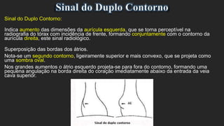 Sinal do Duplo Contorno:
Indica aumento das dimensões da aurícula esquerda, que se torna perceptível na
radiografia do tórax com incidência de frente, formando conjuntamente com o contorno da
aurícula direita, este sinal radiológico.
Superposição das bordas dos átrios.
Nota-se um segundo contorno, ligeiramente superior e mais convexo, que se projeta como
uma sombra oval.
Nos grandes aumentos o átrio esquerdo projeta-se para fora do contorno, formando uma
pequena angulação na borda direita do coração imediatamente abaixo da entrada da veia
cava superior.
 