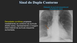 Densidade curvilínea projetada
medialmente ao contorno da aurícula
direita (seta), representando a imagem
infero-lateral da aurícula esquerda
aumentada.
Dilatação da aurícula esquerda por
insuficiência mitral
 