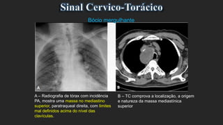 A – Radiografia de tórax com incidência
PA, mostra uma massa no mediastino
superior, paratraqueal direita, com limites
mal definidos acima do nível das
clavículas.
Bócio mergulhante
B – TC comprova a localização, a origem
e natureza da massa mediastínica
superior
 