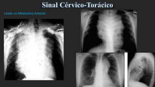 Lesão no Mediastino Anterior
 